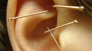 أبحاث كورية:  النحافة عن طريق الوخز بالإبر في الأذن 
