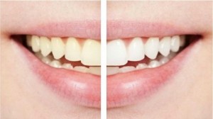 ماهي الأغذية التي تؤدي إلى اصفرار الأسنان؟ 