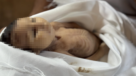 ضحية تجويع جديدة.. وفاة رضيعة جراء سوء التغذية في خان يونس