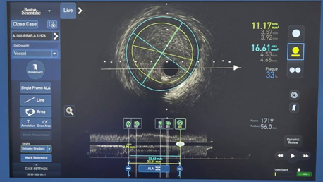 استعمال تقنية متقدمة لعلاج أمراض الشرايين التاجية بمستشفى الرابطة